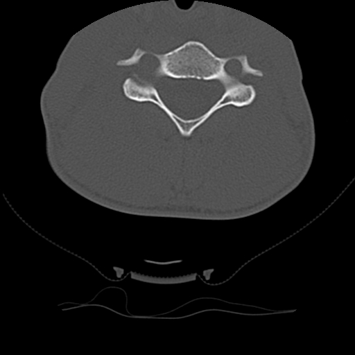 File:Normal trauma spine imaging (age 16) (Radiopaedia 45335-49358 Axial bone window 47).jpg