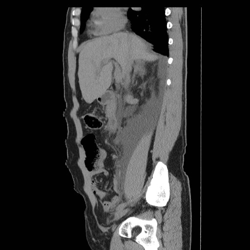 File:Obstructed kidney with perinephric urinoma (Radiopaedia 26889-27066 B 19).jpg