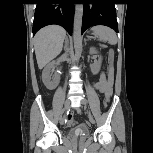 File:Obstructed kidney with perinephric urinoma (Radiopaedia 26889-27067 Coronal non-contrast 11).jpg