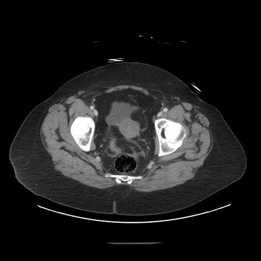 Obstructive distal colonic adenocarcinoma causing cecal perforation (Radiopaedia 86830-102989 A 174).jpg