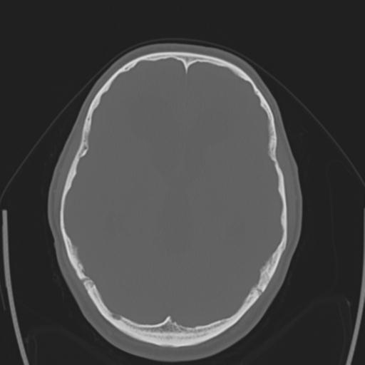 File:Obstructive hydrocephalus (Radiopaedia 30453-31119 Axial bone window 19).jpg