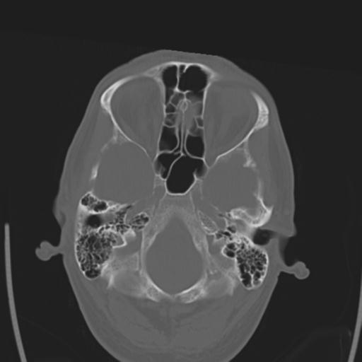 File:Obstructive hydrocephalus (Radiopaedia 30453-31119 Axial bone window 26).jpg