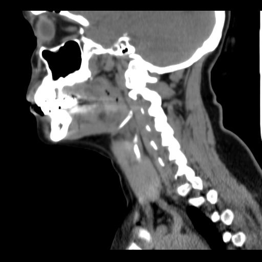 File:Obstructive sleep apnea (CT evaluation) (Radiopaedia 24304-24582 C 46).jpg