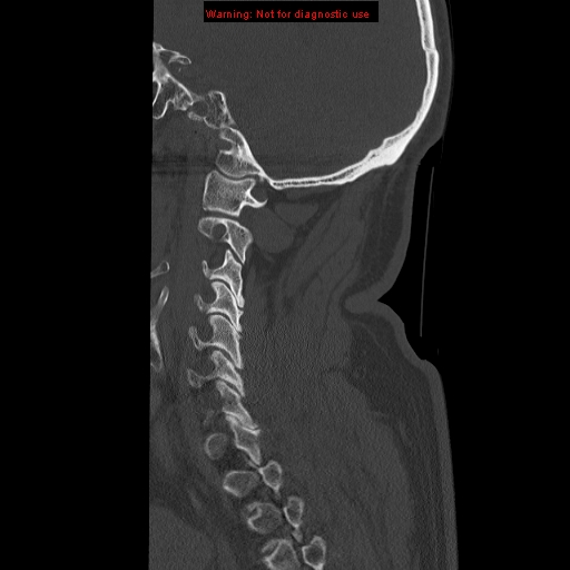 File:Occipital condyle fracture (Radiopaedia 18366-18208 Sagittal bone window 28).jpg