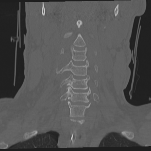 File:Occipital condyle fracture (Radiopaedia 33467-34517 Coronal bone window 22).png