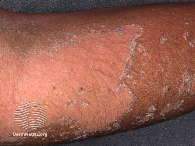 File:Peeling after sunburn (DermNet NZ sunburn1).jpg
