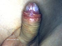File:Penile lichen sclerosus (DermNet NZ 090-small).jpg