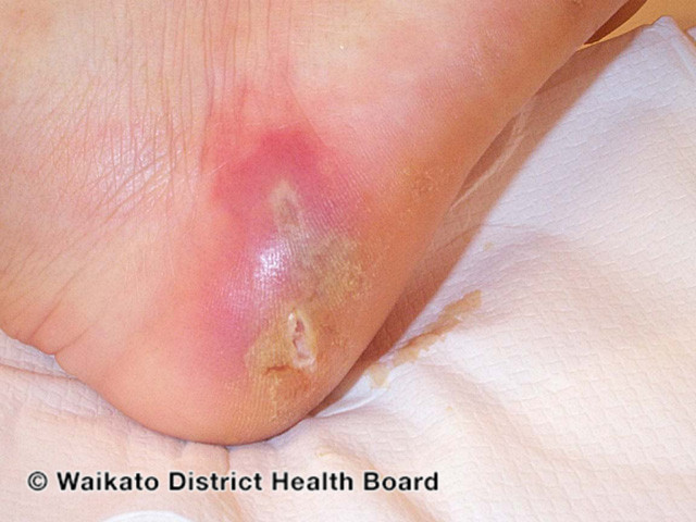 File:Wound infection (DermNet NZ bacterial-w-abscess-3).jpg