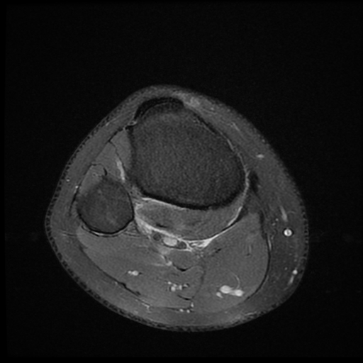File:ACL acute full thickness tear - deep lateral femoral sulcus sign (Radiopaedia 38594-40740 Axial PD fat sat 24).jpg
