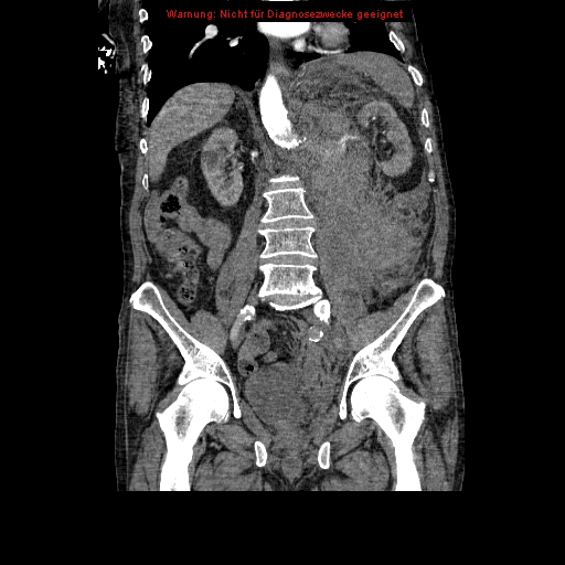 Abdominal aortic aneurysm- extremely large, ruptured (Radiopaedia 19882-19921 Coronal C+ arterial phase 61).jpg