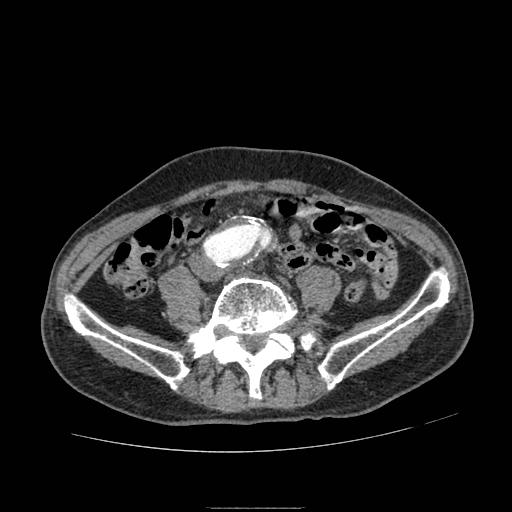 File:Abdominal aortic aneurysm (Radiopaedia 13341-13340 Axial C+ arterial phase 153).jpg