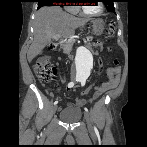 Abdominal aortic aneurysm (Radiopaedia 8190-9038 Coronal C+ arterial phase 52).jpg