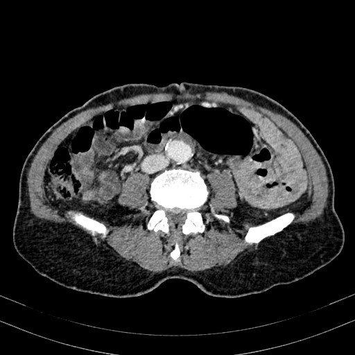 Abdominal aortic aneurysm (Radiopaedia 83581-98689 Axial C+ portal venous phase 67).jpg
