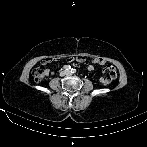 Abdominal aortic aneurysm (Radiopaedia 85063-100606 Axial C+ delayed 84).jpg
