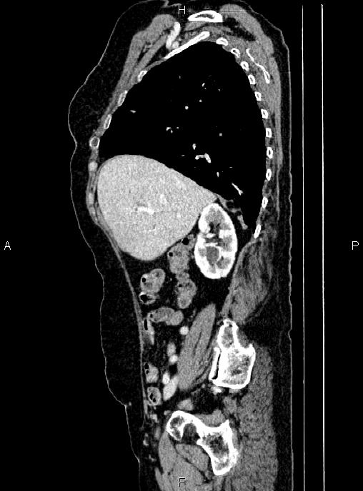 Abdominal aortic aneurysm (Radiopaedia 85063-100606 Sagittal C+ arterial phase 22).jpg