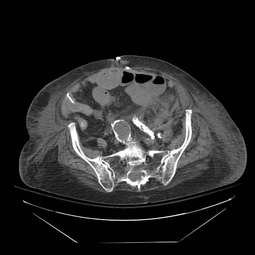 Abdominal aortic aneurysm - impending rupture (Radiopaedia 19233-19247 Axial non-contrast 123).jpg