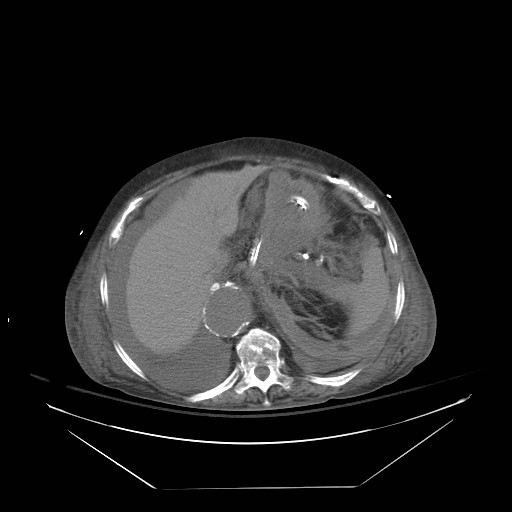 Abdominal aortic aneurysm - impending rupture (Radiopaedia 19233-19247 Axial non-contrast 42).jpg