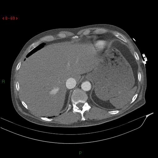 Abdominal aortic aneurysm rupture with aortocaval fistula (Radiopaedia 14897-14841 Axial C+ arterial phase 69).jpg