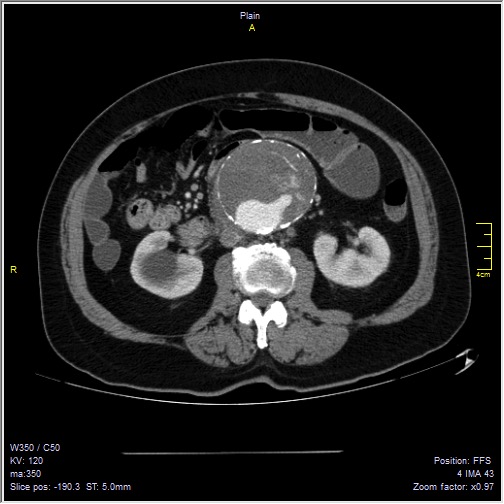 Abdominal aortic aneurysm with thrombus fissuration (Radiopaedia 47340-51926 Axial C+ arterial phase 27).jpg