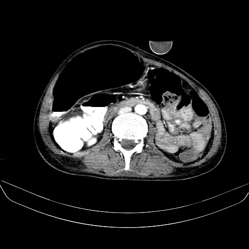 File:Abdominal collection due to previous cecal perforation (Radiopaedia 80831-94320 Axial C+ portal venous phase 103).jpg