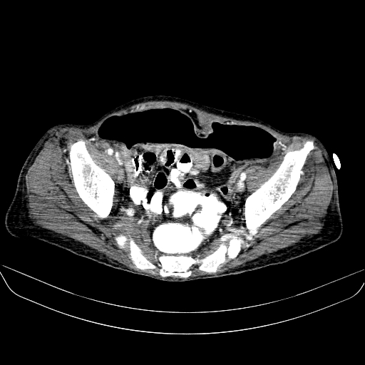 File:Abdominal collection due to previous cecal perforation (Radiopaedia 80831-94320 Axial C+ portal venous phase 173).jpg