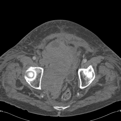 Abdominal hematoma (Radiopaedia 33614-34715 Axial C+ portal venous phase 119).png
