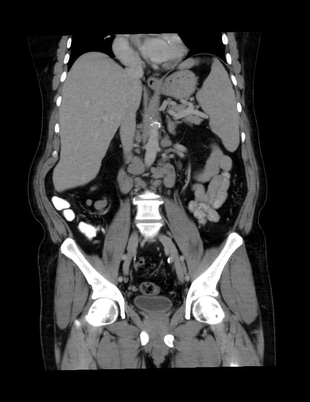 Abdominal lymphoma - with sandwich sign (Radiopaedia 53486-59492 C+ portal venous phase 27).jpg