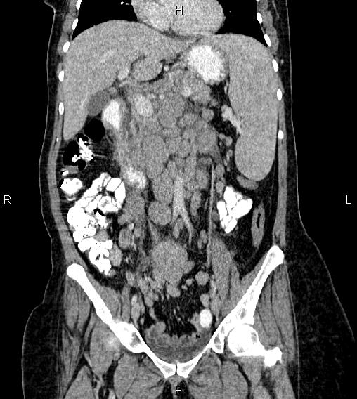 File:Abdominal lymphoma with sandwich sign (Radiopaedia 84378-99704 Coronal C+ portal venous phase 26).jpg