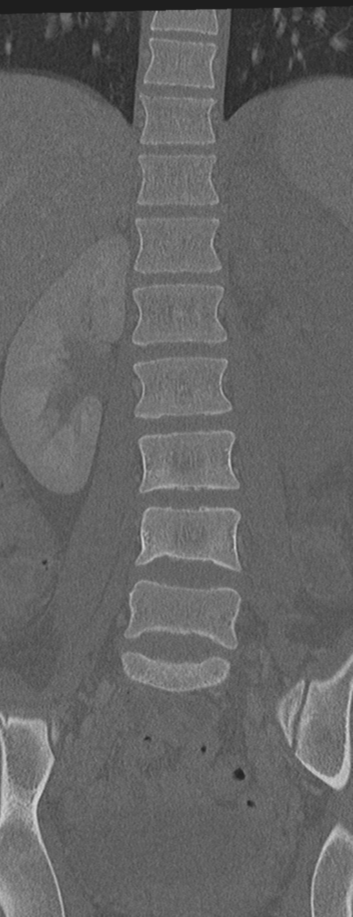 Abdominal multi-trauma - devascularised kidney and liver, spleen and pancreatic lacerations (Radiopaedia 34984-36486 Coronal bone window 30).png