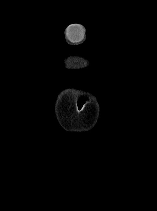 Abdominal wall and retroperitoneal tuberculosis (Radiopaedia 88137-104729 Coronal C+ portal venous phase 3).jpg