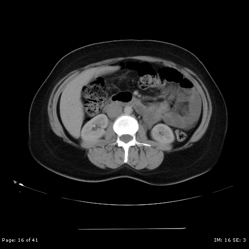 File:Abdominal wall endometriosis (Radiopaedia 25723-25885 Axial C+ portal venous phase 16).jpg