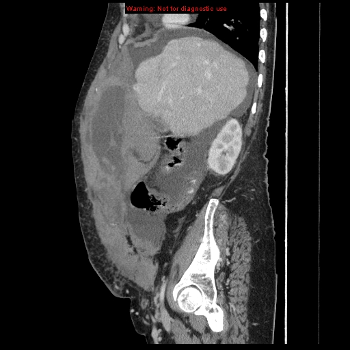 File:Abdominal wall hematoma (Radiopaedia 9427-10112 Sagittal C+ portal venous phase 77).jpg