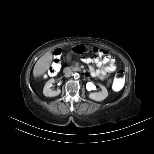 File:Abdominal wall recurrence after colorectal resection for cancer (Radiopaedia 23444-23523 Axial C+ portal venous phase 11).jpg