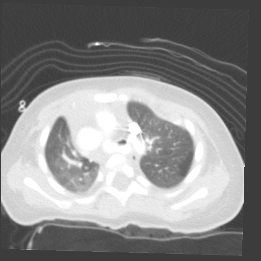 File:Aberrant left pulmonary artery (pulmonary sling) (Radiopaedia 42323-45435 Axial lung window 12).jpg