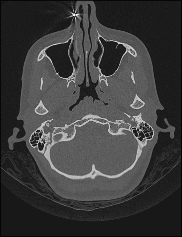 Aberrant right internal carotid artery (Radiopaedia 65191-74198 Axial non-contrast 18).jpg