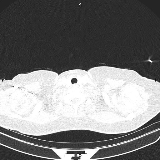 Aberrant right subclavian artery (Radiopaedia 87334-103629 Axial lung window 4).jpg
