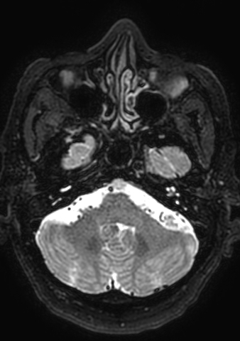 Accessory middle cerebral artery (Radiopaedia 73114-83828 Axial T2 174).jpg