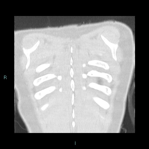 Accidental foreign body aspiration (seamstress needle) (Radiopaedia 77740-89983 Coronal lung window 1).jpg