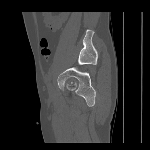 Acetabular and ilial fractures (Radiopaedia 59084-66378 Sagittal bone window 71).jpg