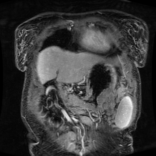 Acinar cell carcinoma of the pancreas (Radiopaedia 75442-86668 Coronal T1 C+ fat sat 154).jpg