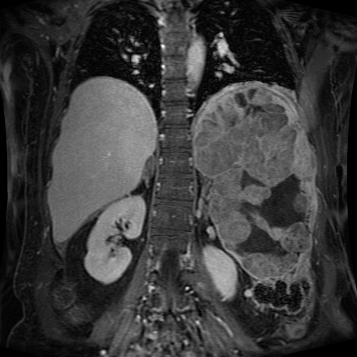 File:Acinar cell carcinoma of the pancreas (Radiopaedia 75442-86668 Coronal T1 C+ fat sat 66).jpg