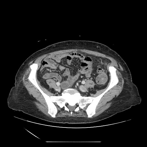 Acinar cell carcinoma of the pancreas (Radiopaedia 75442-86669 Axial C+ portal venous phase 107).jpg