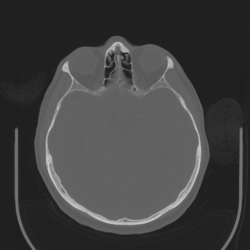 File:Acoustic schwannoma (Radiopaedia 29488-29982 AXIAL BONE THICK non-contrast 20).jpg
