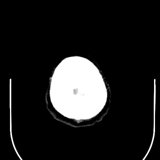 File:Acoustic schwannoma (Radiopaedia 29488-29982 AXIAL THICK non-contrast 47).jpg