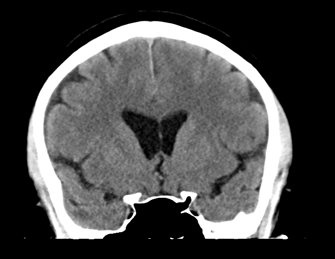 File:Acoustic schwannoma (Radiopaedia 33045-34065 Coronal non-contrast 19).png