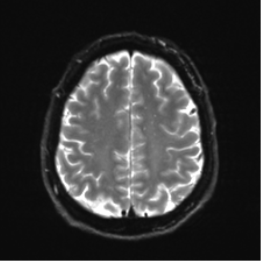 Acoustic schwannoma (Radiopaedia 50846-56358 Axial DWI 23).png