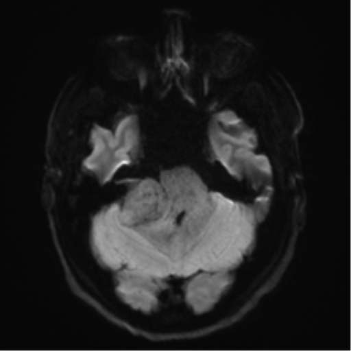 File:Acoustic schwannoma (Radiopaedia 50846-56358 Axial DWI 35).png