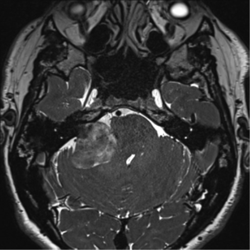 File:Acoustic schwannoma (Radiopaedia 50846-56358 Axial T2 24).png