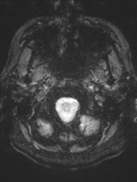 Acoustic schwannoma (Radiopaedia 55729-62281 Axial SWI 2).png