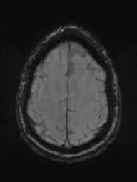 File:Acoustic schwannoma (Radiopaedia 55729-62281 Axial SWI 43).png